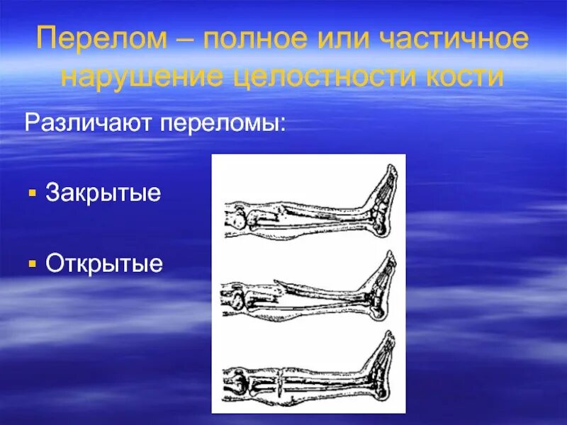 Закрытые и открытые повреждения. Открытый и закрытый перелом.