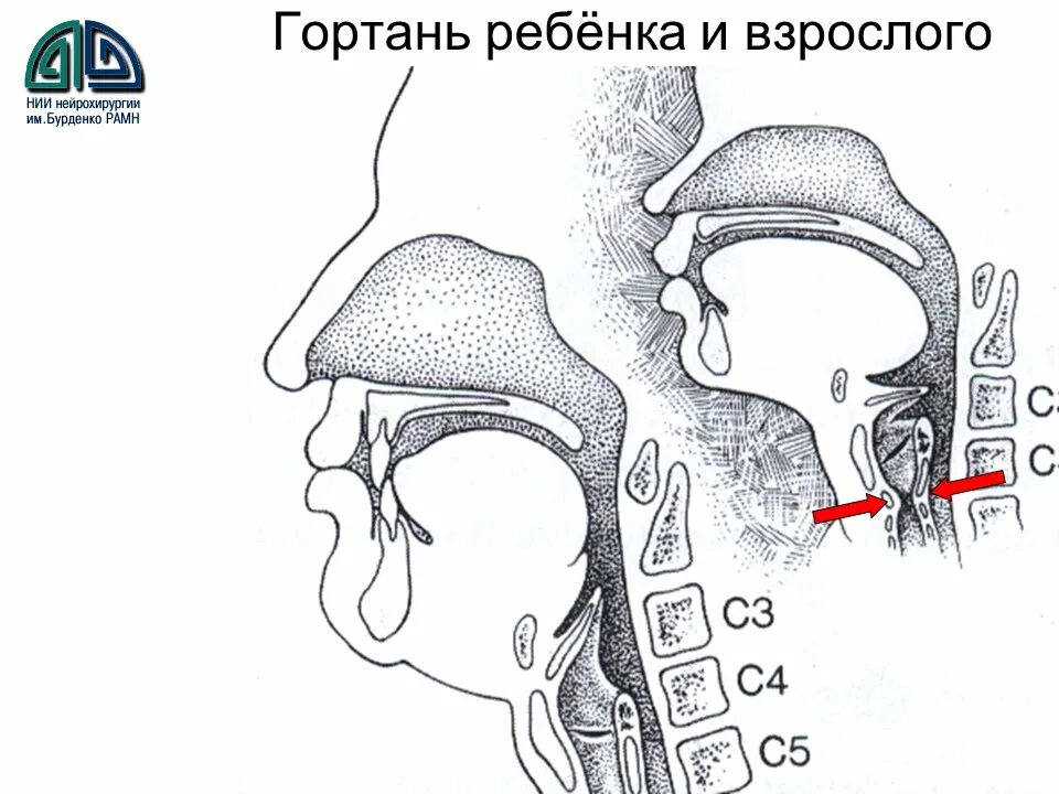 Детская гортань. Гортань ребенка и взрослого.