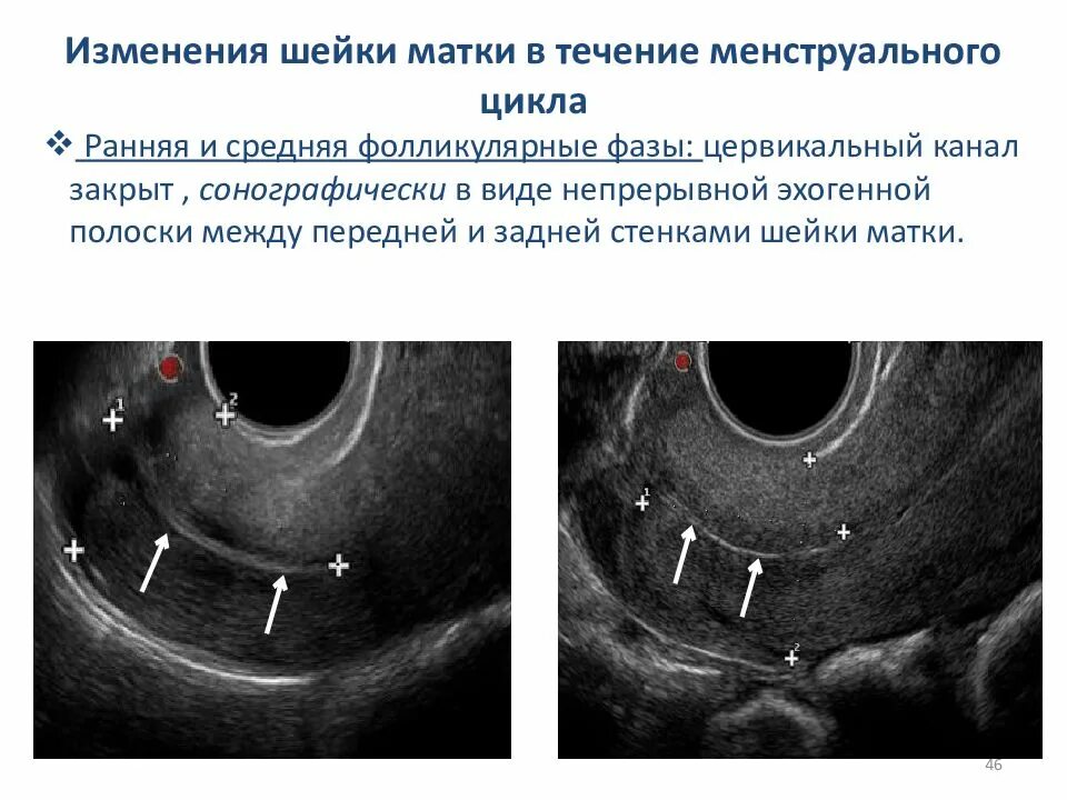 Реактивные изменения шейки. Ультразвуковые изменения в шейке матки по фазам цикла. Изменения на шейке матки при климаксе. Цервикальный канал расширен до 4 мм в фолликулярной фазе.