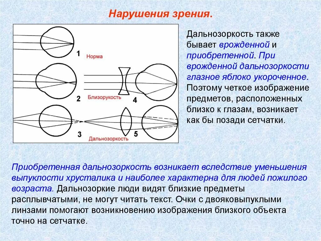 Дальнозоркость что делать. Зрительный анализатор гиперметропия. Двояковыпуклая линза для дальнозоркости. Нарушение зрения дальнозоркость. Близорукость изображение.