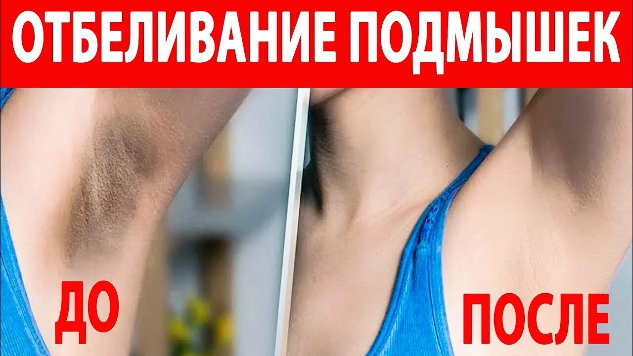 Как отбелить кожу подмышек. Отбеливание зоны подмышек. подмышки отбеливание до после. отбеливание подмышек до и после.