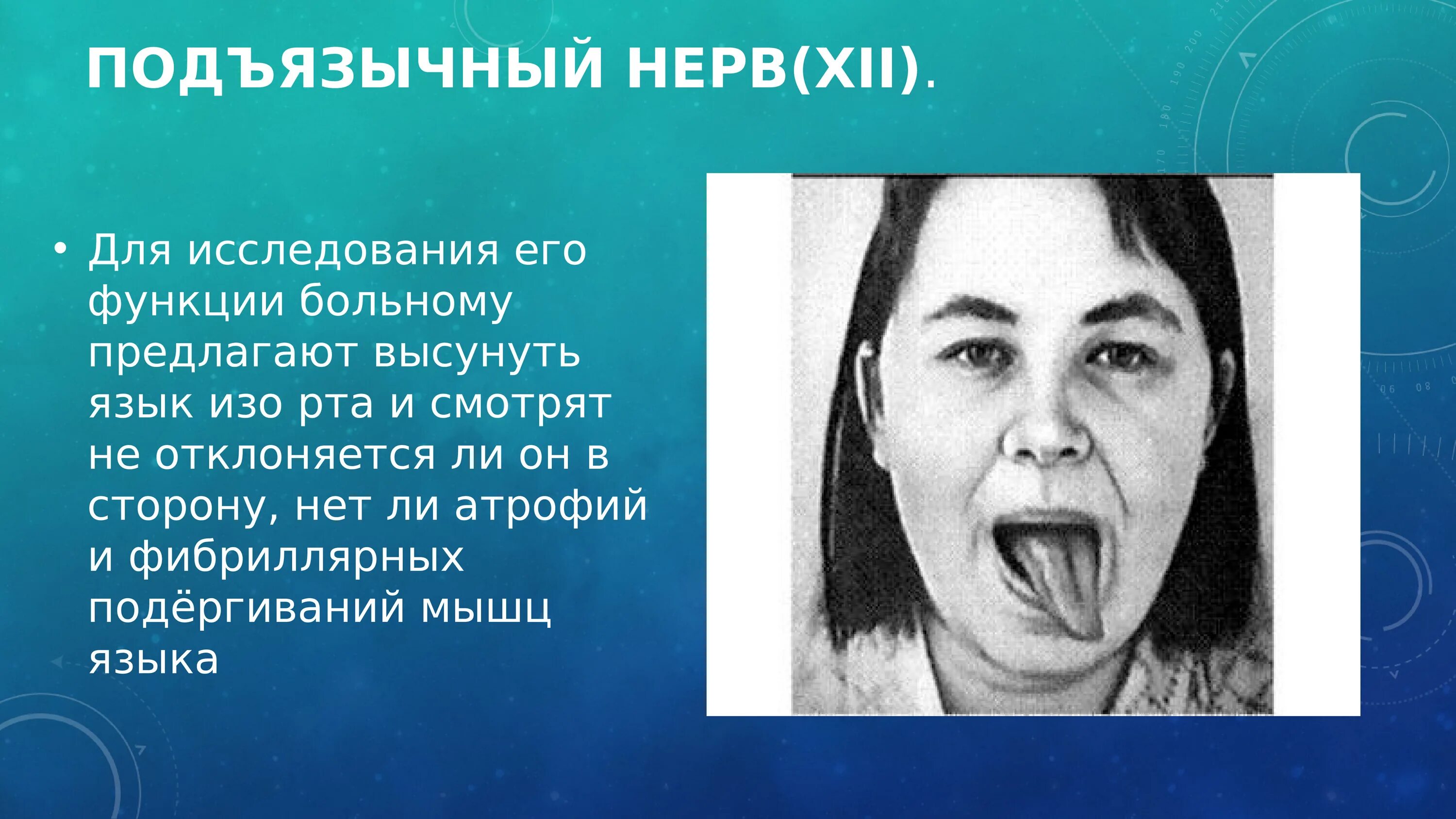 Исследование подъязычного нерва. Симптомы поражения подъязычного нерва. Невропатия подъязычного нерва. Центральный парез языка. Поражение подъязычного нерва