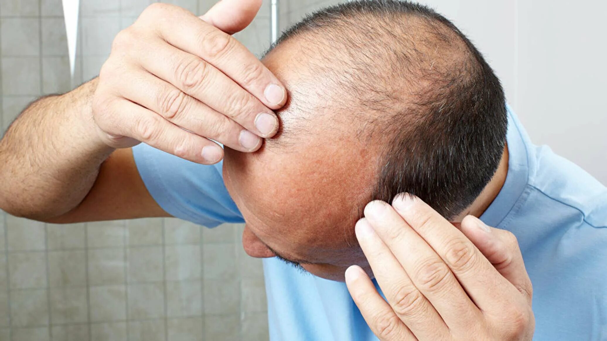 Выпадение волос у мужчин. Выпадение волос причины у молодых мужчин. Receding hairline. Андрогенная алопеция алопеция. Поредение волос у мужчин.