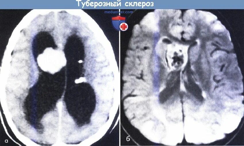 Туберкулезный склероз. Туберозный склероз головного мозга у детей мрт. туберозный склероз кт головного мозга. кт при туберозном склерозе.