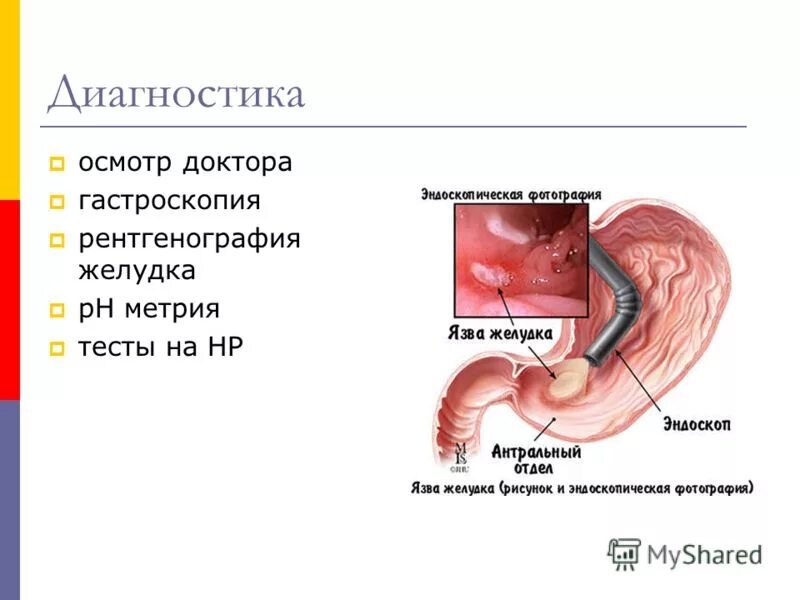 анализ фгдс. после гастроскопии болит желудок. фгдс рекомендации перед процедурой. эндоскопическое исследование толстой кишки колоноскопия. гастроскопия желудка гастрит.