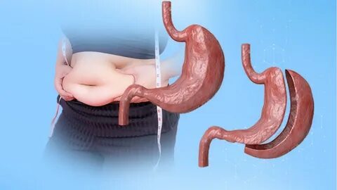 Can You Live a Normal Life After Gastric Sleeve Surgery? 