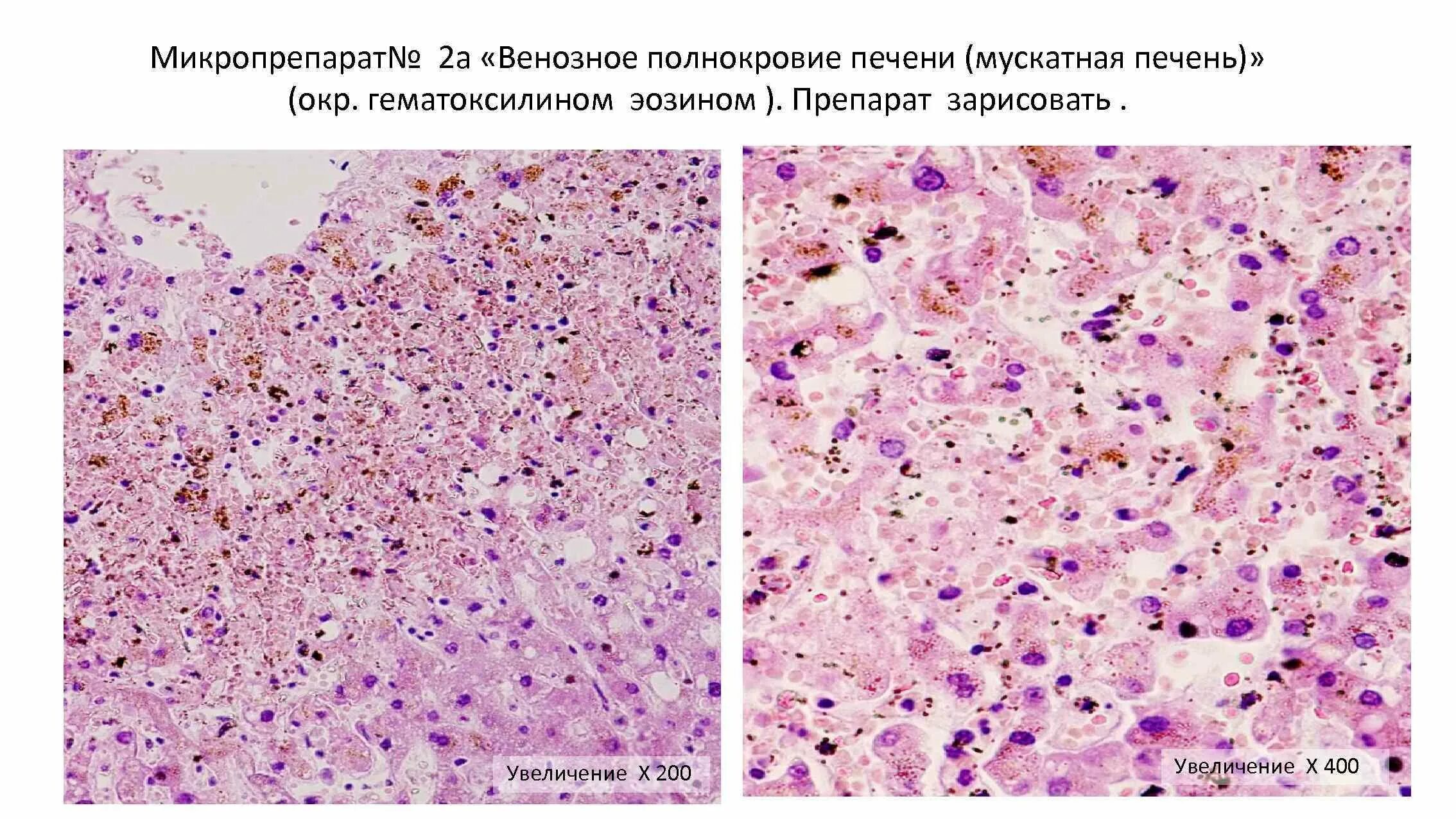 Печень при хроническом венозном застое. Венозное полнокровие печени микропрепарат. Мускатная печень гистология. Острое венозное полнокровие печени гистология. Венозное полнокровие печени препарат.