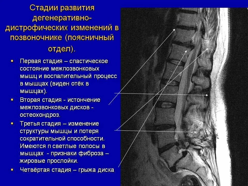 Остеохондроз поясничного отдела позвоночника периоды. Остеохондроза дисков пояснично-крестцового отдела. Смещение дисков позвоночника поясничного отдела. Смещение диска в поясничном отделе. Остеохондроз грудного отдела позвоночника 1 степени.