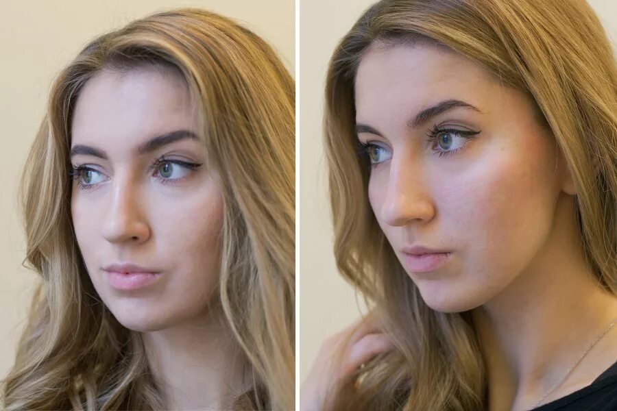 Скулы филлерами. Скулы до и после. Моделирование лица до и после. Пластика скул. Моделирование скул до и после.