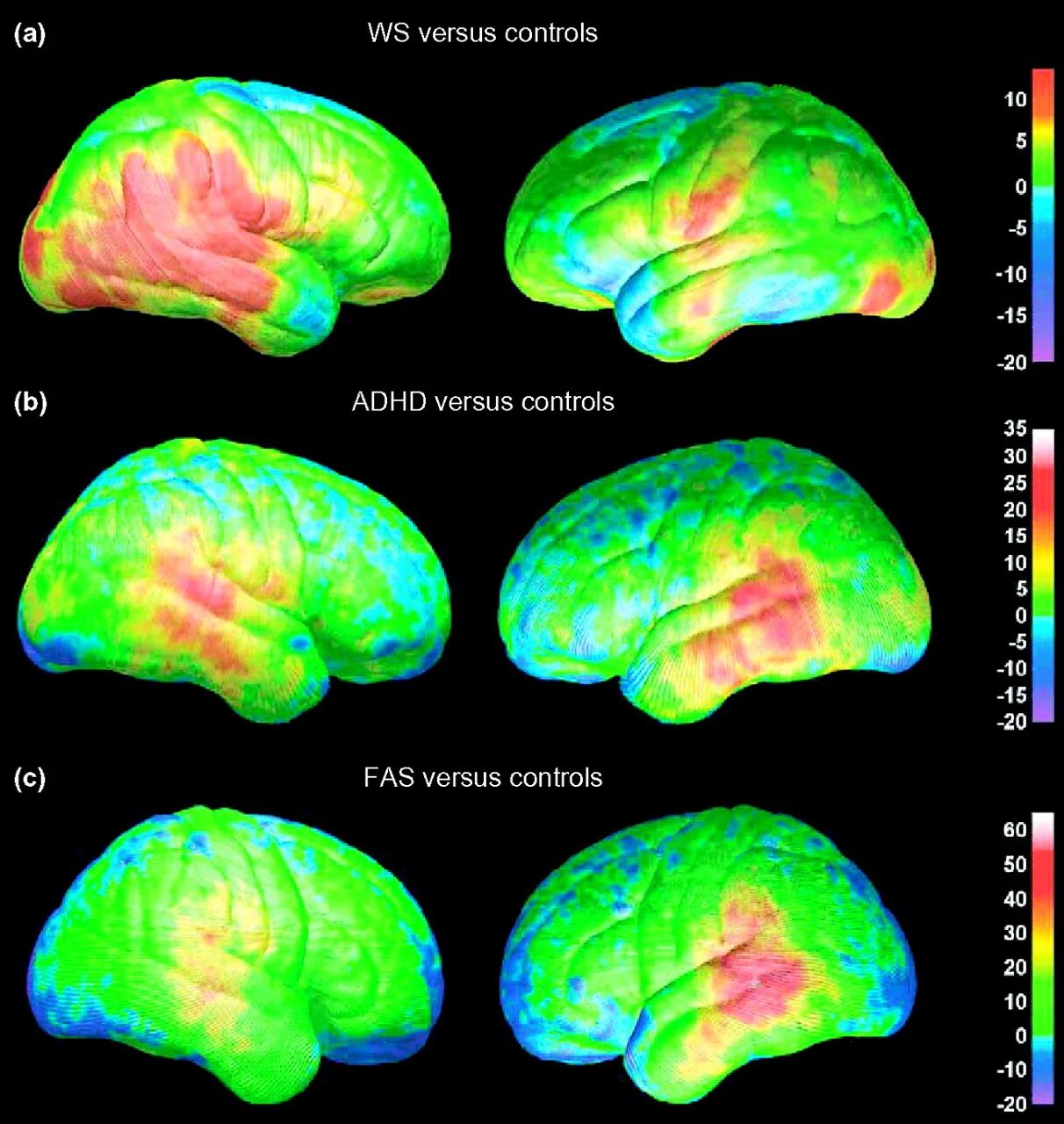 ADHD Brain. Normal Brain and ADHD Brain. Brain with ADHD. ADHD Brain differences. Brain vs brain