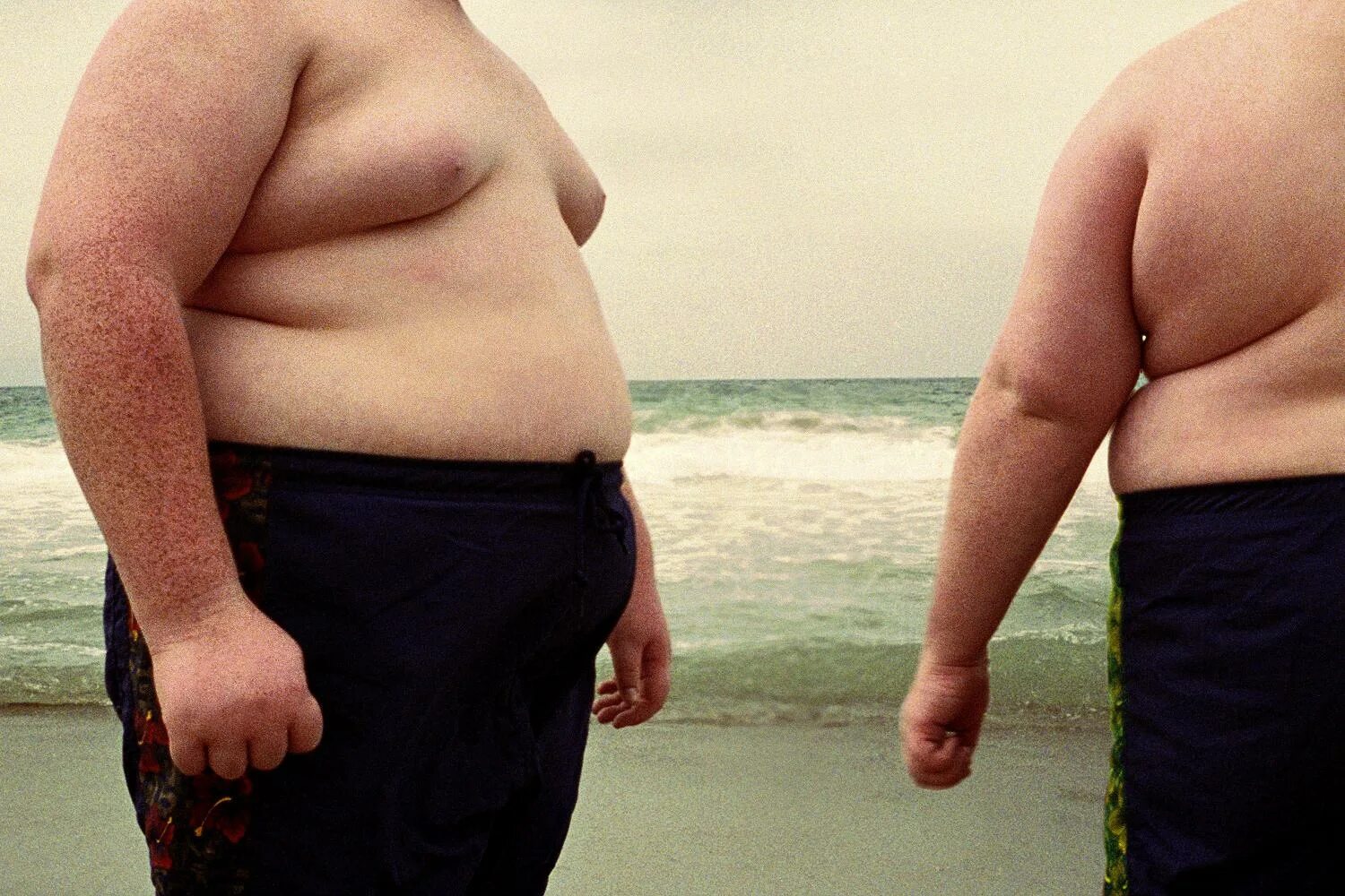 Много толстых мужиков. Ожирение третьей степени (морбидное).