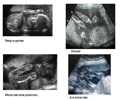 УЗИ плода мальчика в 20 недель беременности. УЗИ 22 недели беременности девочка. Ребенок 22 недели беременности УЗИ девочка. УЗИ на 20 неделе беременности пол ребенка. Можно ли на 22 неделе