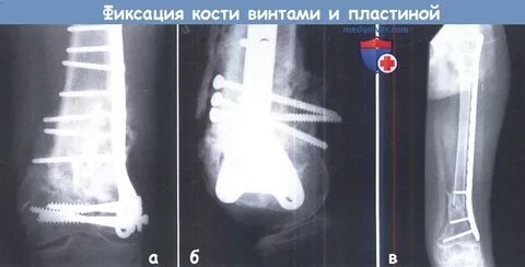 Фиксатор костей