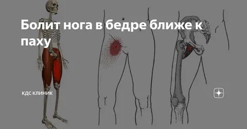 Болит нога в бедре ближе к паху КДС Клиник Дзен