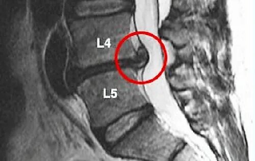 Грыжа диска l4 l5. Позвонковые диски l4-l5. задняя медианная грыжа диска l5-s1 6мм. межпозвоночная грыжа симптомы l5 l4 l3.
