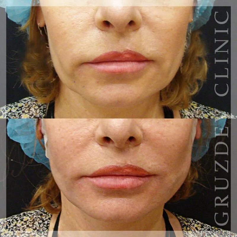Как убрать брыли и подтянуть. Филлеры от брылей на лице. Брыли лаврова. Платизмопластика платизмопластика. Как убрать брыли и подтянуть.
