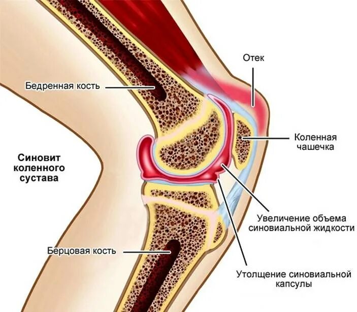 Синовит коленного сустава. Вторичный и первичный синовит. Мр признаки синовита. Синовит левого коленного сустава. Мр признаки синовита.