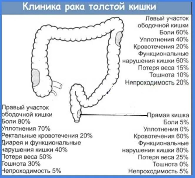 Рак кишки симптомы признаки у женщин. Опухоли толстого кишечника клиника. опухоль восходящего отдела толстой кишки. опухоли прямой кишки клиника. опухоль толстого кишечника симптомы.
