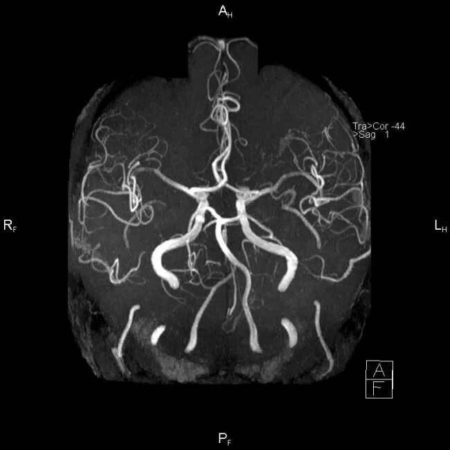 Виллизиев круг на мрт норма. Виллизиев круг мрт. Кт ангиография сосудов головного мозга анатомия. Мрт сосудов головного мозга Виллизиев круг.