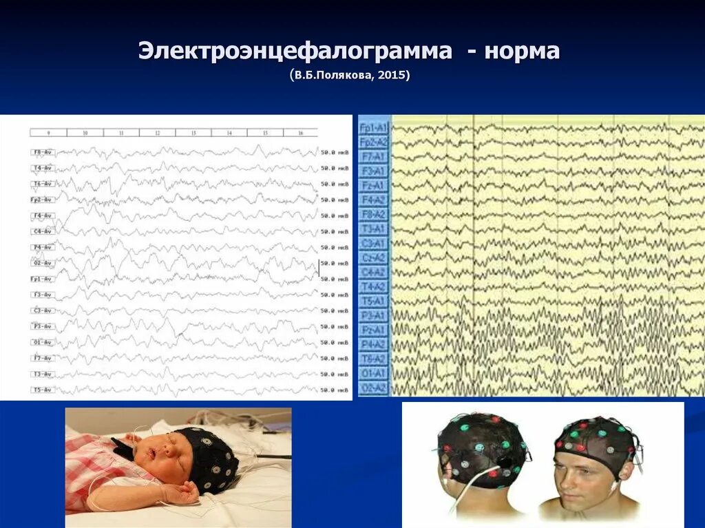 Ээг челны. Электроэнцефалография норма. ЭЭГ. ЭЭГ норма. ЭЭГ детям.