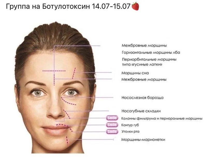 Botox was injected into five eyebrow areas and eight crow’s feet (four... Downlo