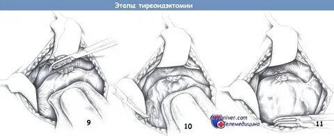 Щитовидные узлы операция