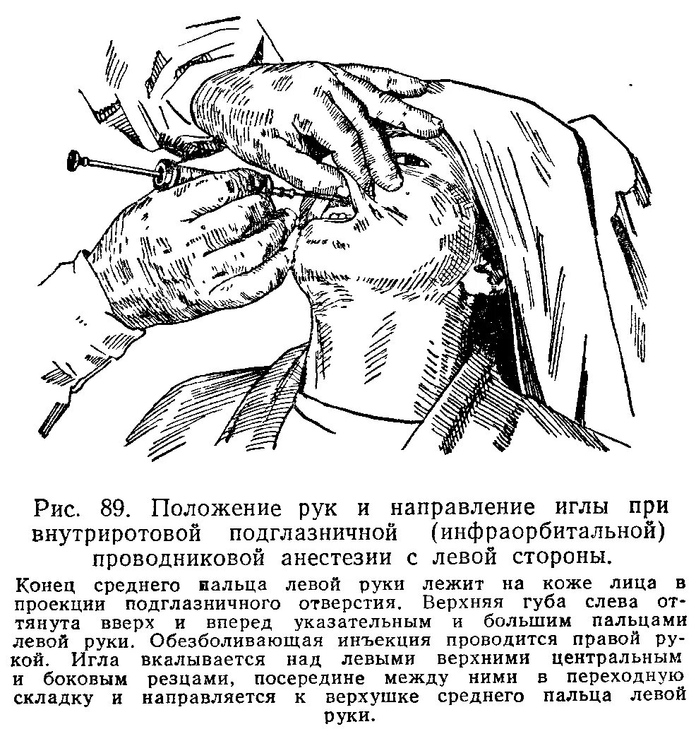 Подглазничная анестезия. Инфраорбитальная проводниковая анестезия. проводниковой анестезии чло. проводниковая анестезия в хирургии. методы проводниковой анестезии.