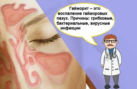 Признаки гайморита у взрослых с температурой
