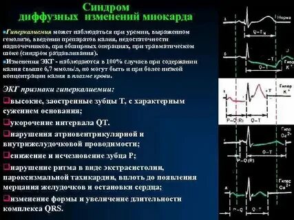 Диффузные нарушения миокарда лж