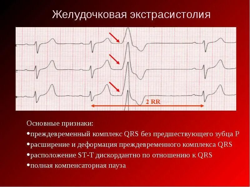 Желудочковая экстрасистолия на ЭКГ. Единичная желудочковая экстрасистолия на ЭКГ. Аберрантные экстрасистолы на ЭКГ. Желудочковая и наджелудочковая экстрасистолия. Типы желудочковых экстрасистол