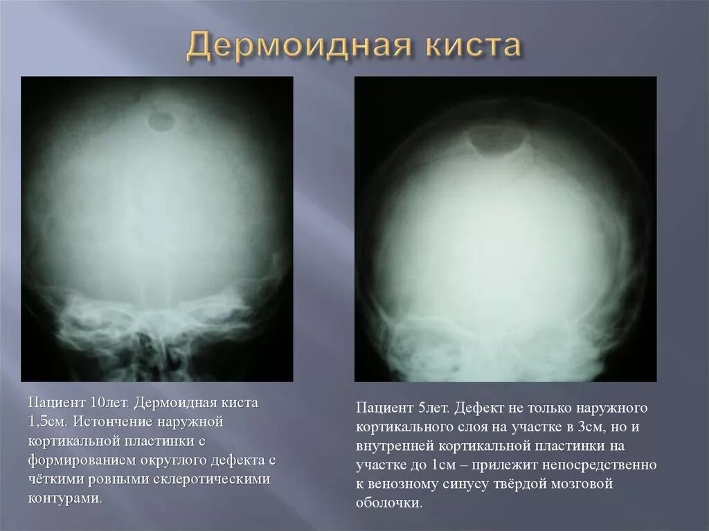 Тератодермоидная киста. Лимбальная дермоидная киста. Дермоидная киста надбровная. Опухоль в капсуле