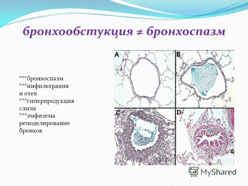 ремоделирование бронхов