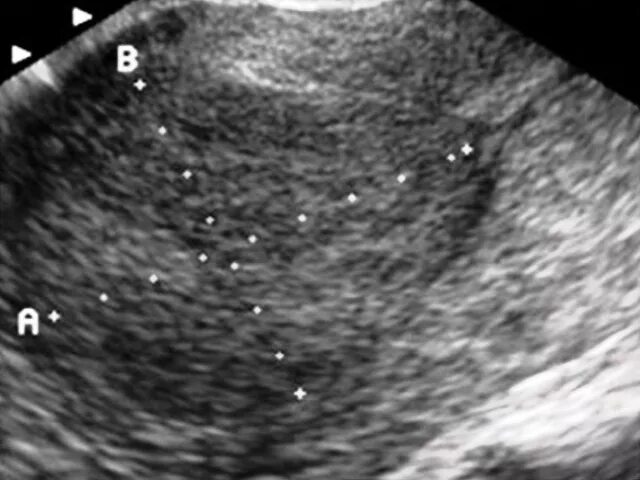 Карцинома эндометрия матки УЗИ. Киста эндометрия матки. Эндометриоз серозоцеле. Рак шейки матки на узи виден
