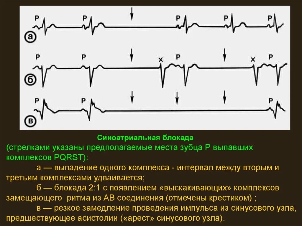 Комплекс блокада. Синоатриальные блокады на ЭКГ. ЭКГ признаки синоатриальной блокады. Са блокада на ЭКГ. Синусовая блокада на ЭКГ.