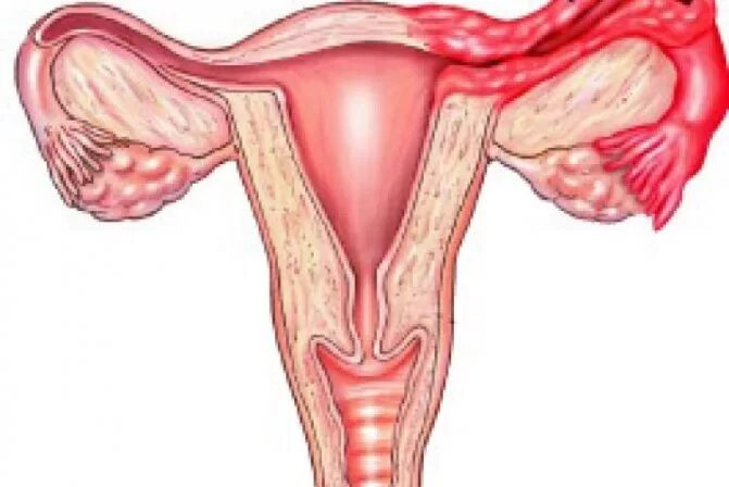 сальпингоофорит (аднексит). воспаление женских придатков. у женщины болит живот. подострый хронический сальпингоофорит. воспаление придатков матки симптомы.
