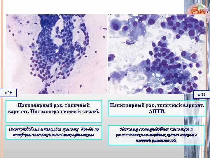 Папиллярная карцинома щитовидной железы гистология. Цитологическая картина папиллярной карциномы. Иммуногистохимическое исследование опухоли щитовидной железы. Цитологическая картина папиллярной карциномы щитовидной железы. Папиллярный рак после операции