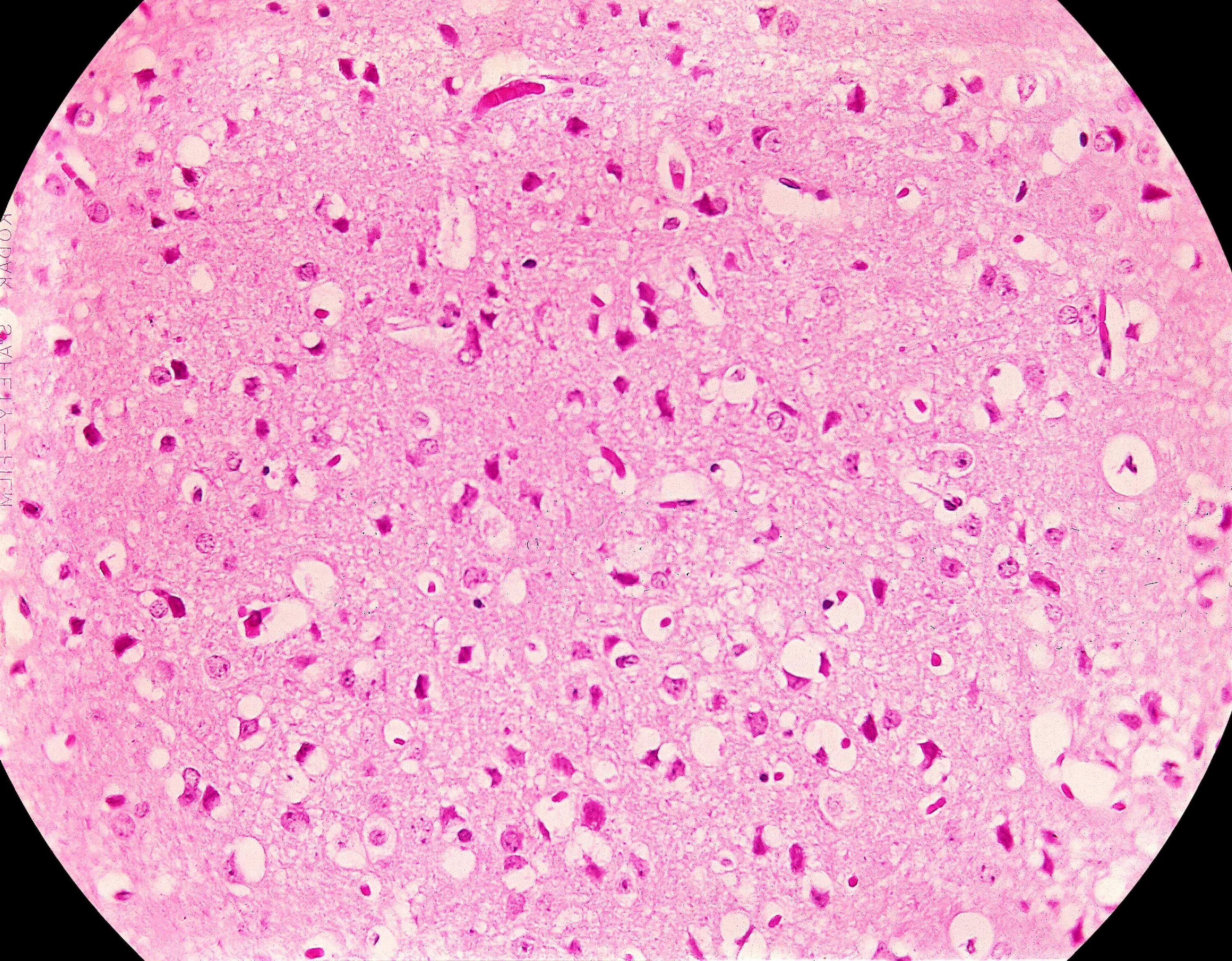 Микропрепарат головного мозга. Цитомегаловирусный энцефалит гистология. Вирусный энцефалит гистология. Цитомегаловирусная инфекция головного мозга гистология. Цитомегаловирусная инфекция гистология.