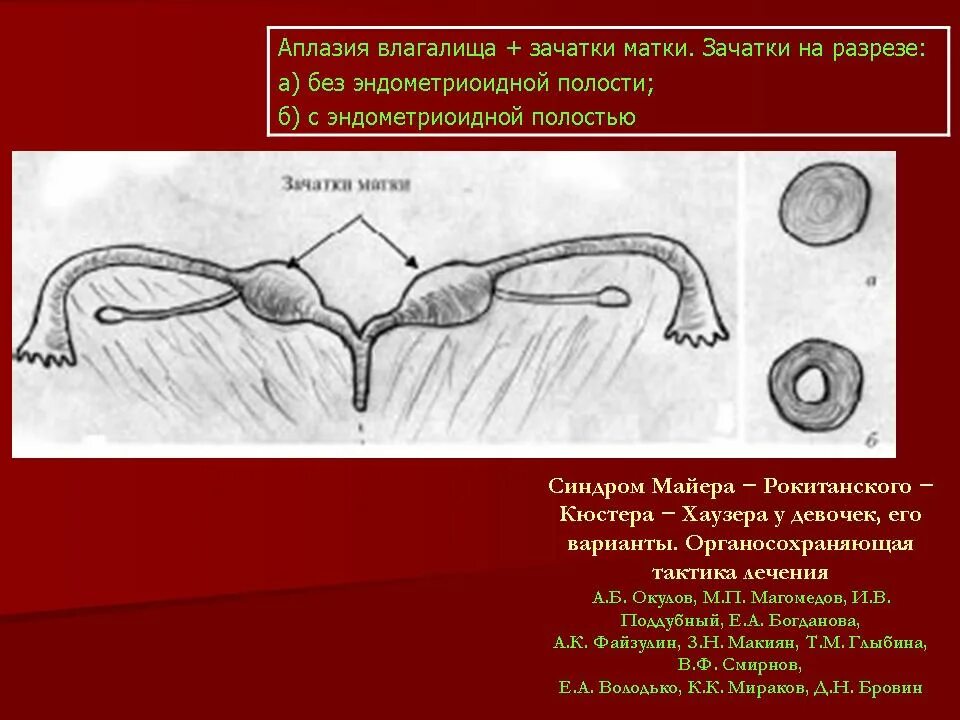 Аномалии развития матки