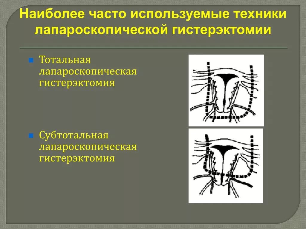 Тотальная и субтотальная гистерэктомия. Лапароскопическая субтотальная гистерэктомия. Техника субтотальной гистерэктомии. Экстирпация матки (тотальная гистерэктомия).