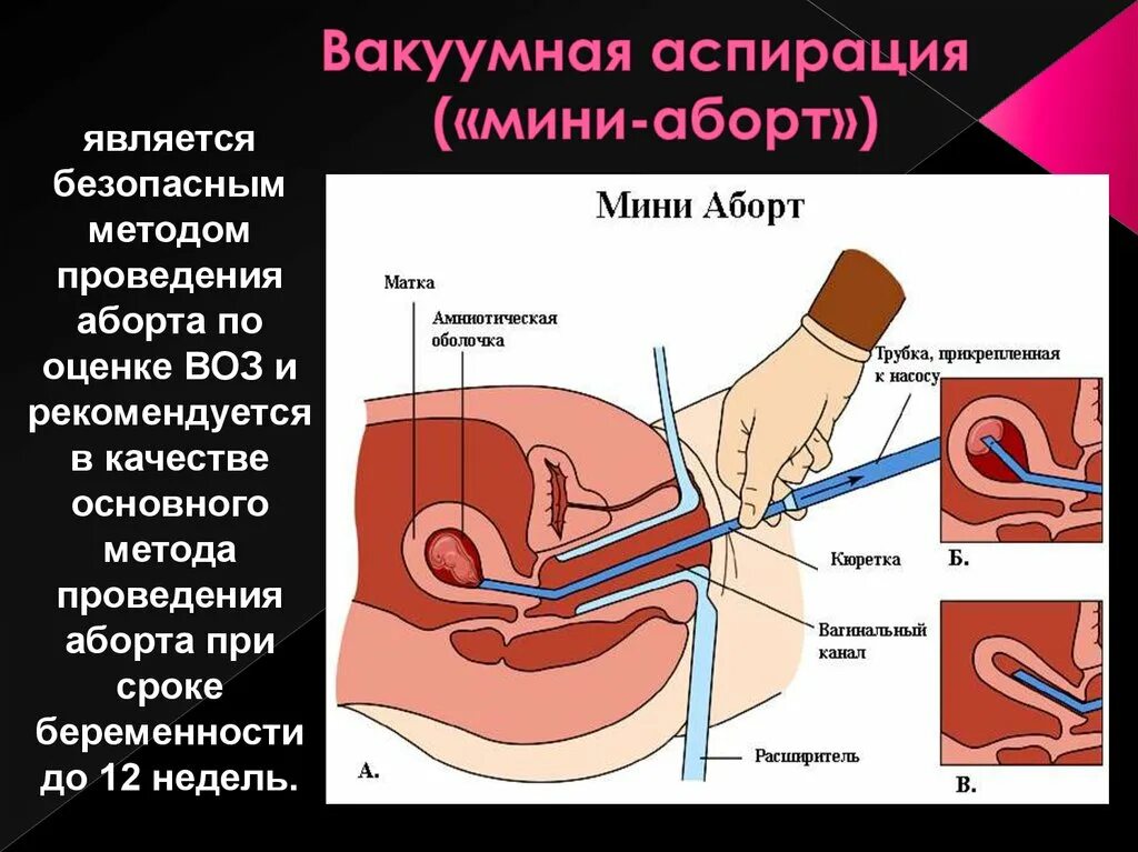 Сколько длится вакуумный. Мини аборт вакуумным методом. Вакуумная аспирация матки аборт. Вакуумный метод прерывания. Метод прерывание беременности вакуумная аспирация..