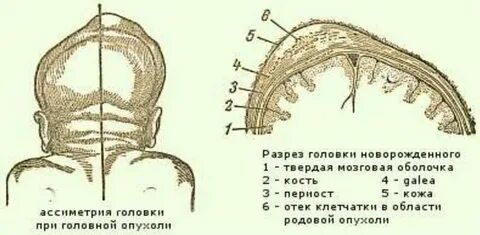 Отек новорожденного после родов