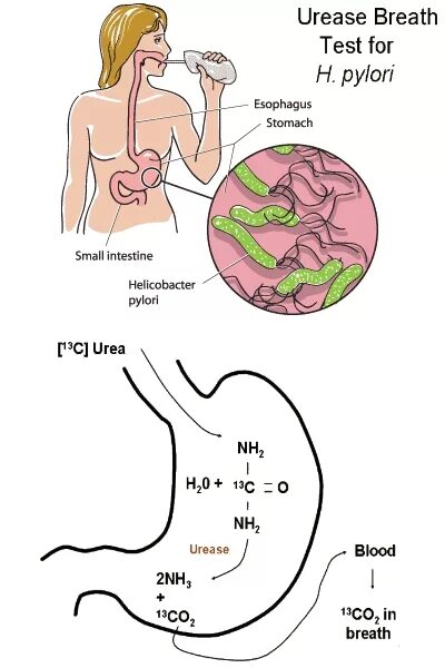 Как подготовиться к тесту на хеликобактер. Уреаза helicobacter pylori. тесты на h pylori. дыхательный уреазный тест на хеликобактер пилори. тест на хеликобактерии желудка.