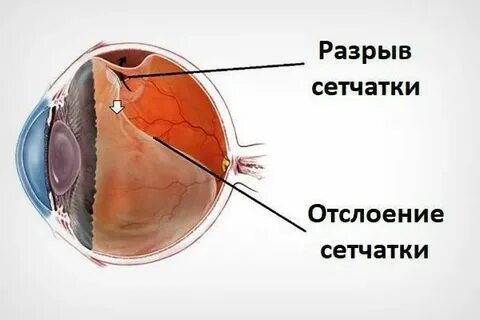 Собирается сетчатку