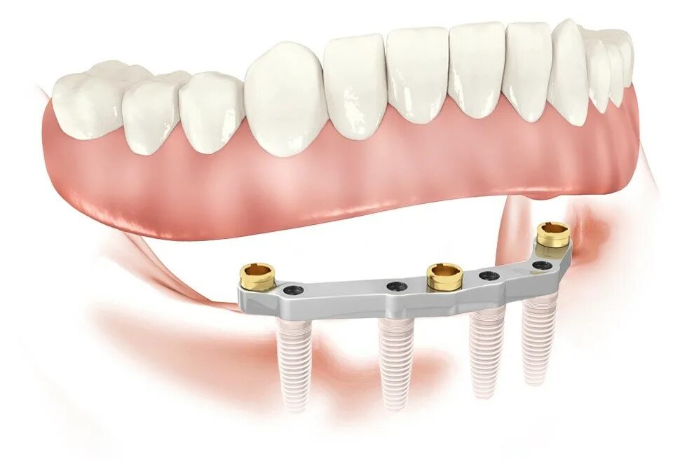 Имплантат NEOBIOTECH. Несъемные протезы зубов. Съемный протез с опорой на имплантаты.