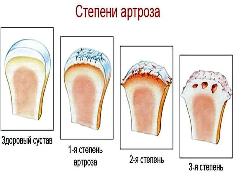 Деформирующий артроз коленного сустава схема. Остеоартроз плечевого сустава 1. Артроз плечелопаточного сустава 1 степени. Остеоартроз 1-2 степени.