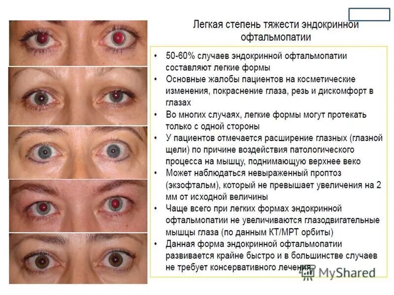 Болит глаз плохо видит. Эндокринная офтальмопатия. Симптомы офтальмопатии. Эндокринная офтальмопатия глазные симптомы. Симптомы эндокринной офтальмопатии.