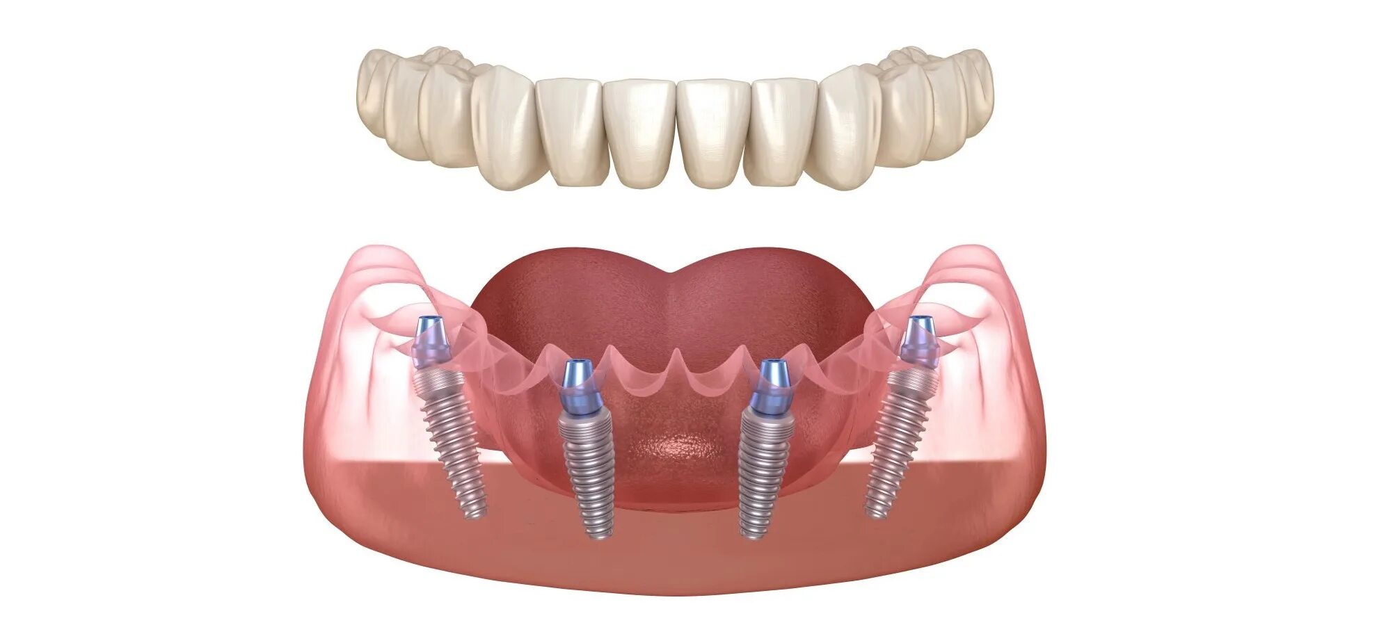 Имплантация зубов all on 4. Имплантация челюсти на 4 имплантах. Имплантация зубов all on 6