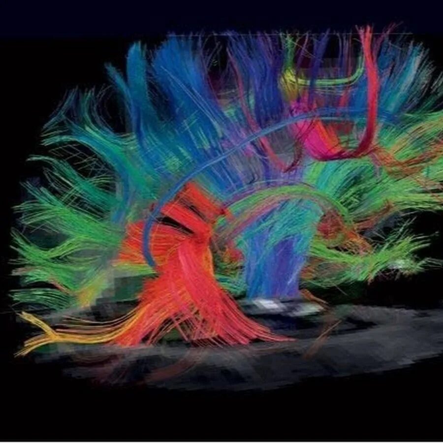 Diffusion tensor. Трактография головного мозга. диффузионно тензорная визуализация. diffusion tensor imaging (dti). трактография мрт.