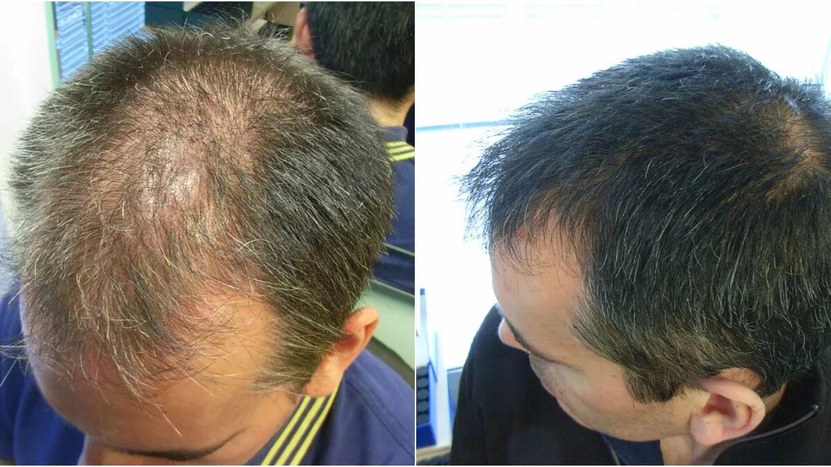 Hair loss complex. Tablet for treating severe alopecia Areata.