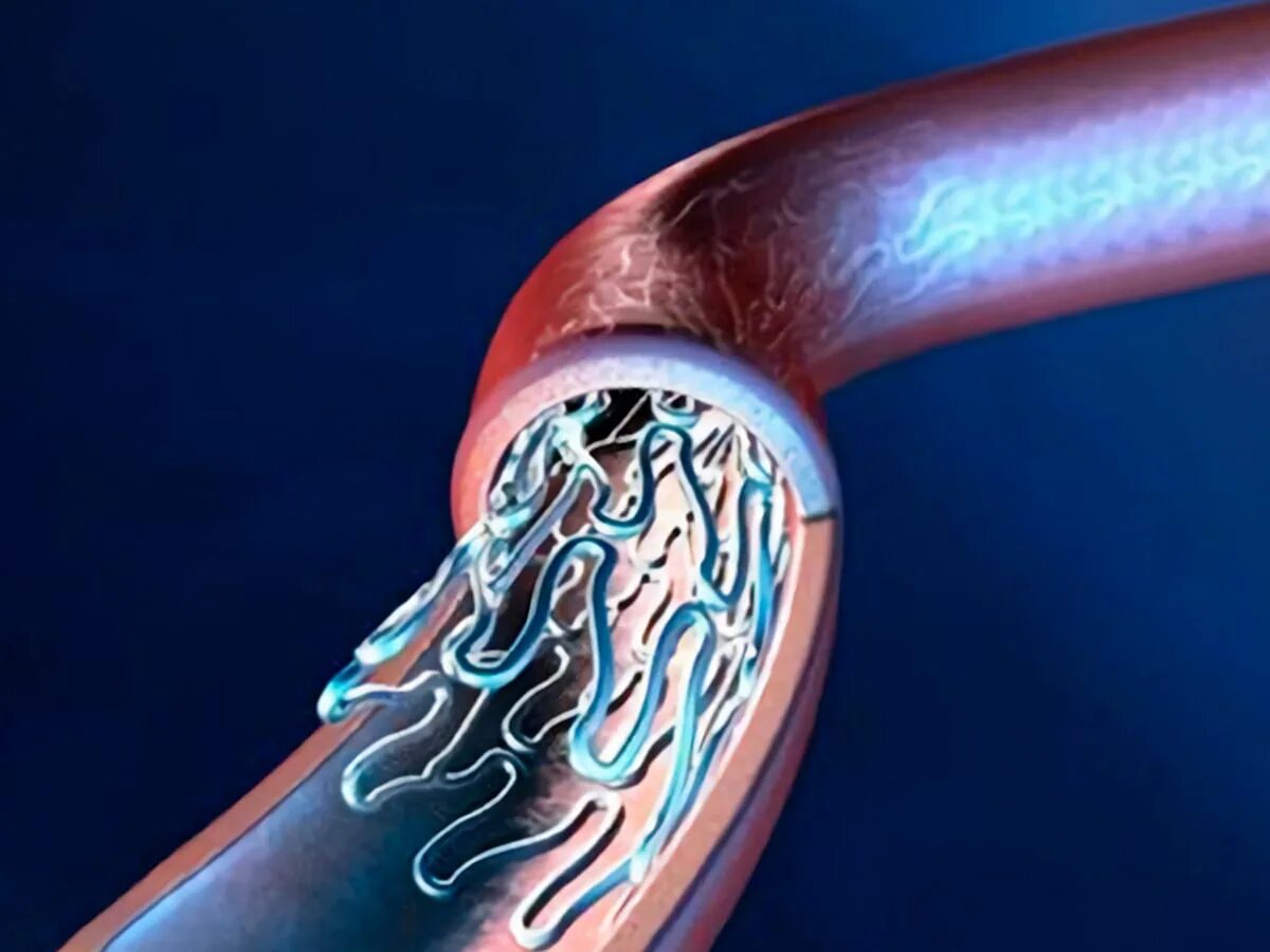 Лекарственный стент. Стентоник коронарные стенты. Стент с лекарственным покрытием. Коронарные стенты с лекарственным покрытием.